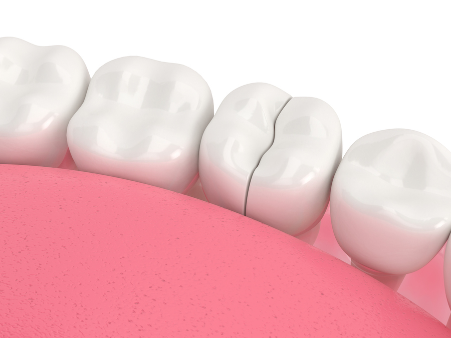 medically accurate 3d render of a cracked tooth