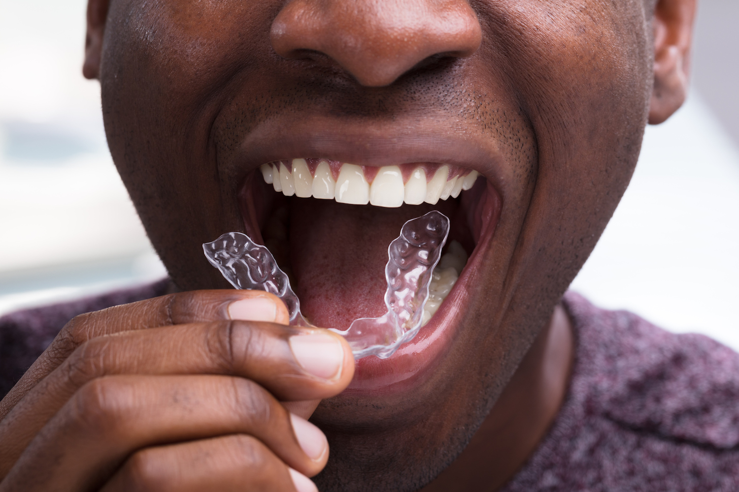 invisalign treatment, advantages of invisalign, orthodontics, braces, clear aligners, straighten teeth, smile